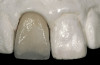 Fig 5. The “over-contoured” abutment design will displace the soft tissue apically. This design can be used strategically to reposition the peri-implant tissue to its desired position.