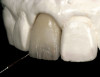 Fig 6. Useful in conjunction with immediate load scenarios, the “under-contoured” abutment design allows space for a potential increase in soft-tissue volume or a draping of tissue coronally. This design is created in the provisional restoration and left in position for at least 4 months.