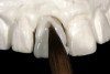 Fig 7. A hollow acrylic tooth shell, clinical screw, and provisional abutment are the components needed to create a screw-retained provisional restoration. Note that this provisional abutment has been modified to a narrowed emergence profile, and the retentive portion has been masked with an opaquing composite resin.