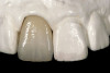 Fig 8. Some implant abutments flare drastically at the connection with the implant. This will compromise blood supply to the area, encroach on the peri-implant biologic width, and likely result in a more apical position of the bone and soft tissue. This design should be modified for use in the esthetic zone.