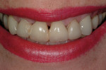 Figure 1  The patient’s initial smile revealed an avulsed right central incisor, unesthetic veneer restorations, and loss of papillae.