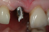 Fig 11. The provisional restoration for immediate loading is designed to maximize the development of peri-implant tissue through the use of a narrowed emergence profile and open gingival embrasures.