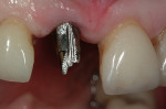 Figure 2  After implant integration, a temporary cylinder was prepared for a provisional restoration.