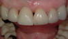 Fig 12. The provisional restoration in position on the day of delivery. Note the narrow abutment emergence contour as it emerges from the tissue. Allowing the gingival embrasures to remain open will allow them to mature to a maximum length.