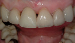 Figure 3  An implant-level provisional restoration helped to develop soft-tissue profiles.