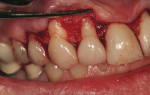 Figure 4  Right view of the crown-lengthening procedure, which was performed to achieve ideal tooth proportions and symmetrical gingival levels.