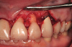 Figure 5  Left view of the crown-lengthening procedure.