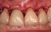 Fig 15. Use of a “pseudo CEJ” design at the position of the desired free gingival margin will help apply pressure to the soft tissue in a controlled manner to move it apically to the ideal position.