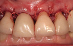 Figure 6  Frontal view of the crown-lengthening procedure.