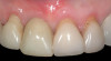 Fig 16. Additional bulk has been added to the area of the free gingival margin, but the narrow emergence contour has been preserved where possible. This modified form will be placed back on the implant and the soft tissue allowed to mature for 4 to 6 weeks.