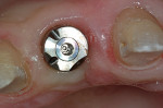 Figure 9  An occlusal view of the abutment reveals facets that encode critical information about the implant.