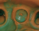 Figure 10  The facets on the healing abutment were captured in the impression.