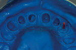 Figure 13  A polyvinylsiloxane impression was made of the abutment secured in place and the prepared teeth.
