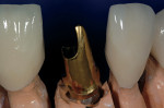 Figure 14  The final abutment on the final cast allowed for simultaneous fabrication of the anterior ceramic crowns.
