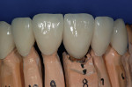 Figure 15  The facial view illustrates the ceramic crowns seated on the preparations and the abutment.