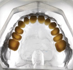 Fig 10. The artificial teeth are placed back into the clear silicone matrix.
