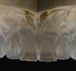 Fig 15 and Fig 16. The master model is removed to reveal an accurate duplicate of the original prosthesis.
