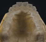 Fig 15 and Fig 16. The master model is removed to reveal an accurate duplicate of the original prosthesis.