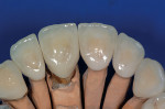 Figure 16  Normal palatal contours were achieved on both the teeth and implant.