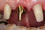 Figure 17  The abutment was seated on the implant.