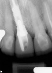 Figure 18  A digital radiograph verified complete seating of the abutment on the implant.