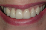 Figure 19  In the final restoration, ceramic crowns of normal proportions and appropriate shade have restored esthetic balance.