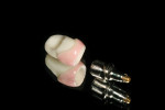 Figure 11Margins were placed on abutment to correspond to slightly supragingival margins to facilitate easy final cement removal. All lithium disilicate below gingival height was stained to match natural tissue shading, thus reducing shine-through of implant abutment through tissue, which would compromise final esthetic result.