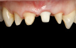 Figure 19 Preparations and abutment after provisionals removed.