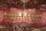 Figure 5 Post-orthodontic retracted MIP showing space created.