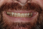 Figure 8 Close-up of smile with composite “test teeth.”