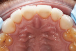 Figure 11 Maxillary view of completed crowns.