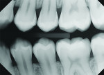 Better coverage of the canine-premolar contact area.
