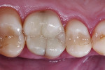 Post-treatment result. The direct composite restoration blends in well to the surrounding hard dental tissue.