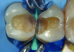 G-rings of different tine lengths were placed
so teeth could be restored simultaneously.