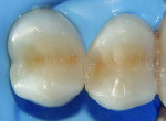 Excess adhesive and composite were removed and the occlusal anatomy was contoured.