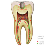 Visit Brasseler USA's Restorative Endodontics website at www.restorativeendo.com