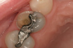 Figure 1  Preoperative view of the patient’s tooth fractures.