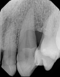 Case 3 post-treatment radiograph showing 4-mm probing depth at 4.5-year follow-up.