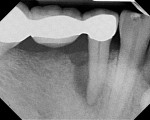 Case 1 pretreatment radiograph showing 12-mm probing depth on the distal aspect of tooth No. 29.