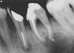 Figure 9  View of the periapical lesions present that are associated with lower premolar and molar, which were obturated with the Resilon system upon completion of endodontic treatment. (Courtesy of Dr. Joseph Maggio)