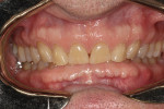 Figure 3 This photograph revealed 100% overbite and facial exostoses.