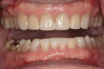 Figure 13 With the teeth separated, the new mandibular occlusal plane was evident.