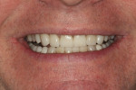 Figure 23 Postoperative photograph of the successful new smile.