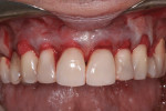 Figure 3 The ADM was inserted into the mucogingival tunnel using access areas between teeth Nos. 5 to 6 and 11 to 12.