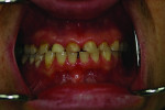 Figure 2 Retracted frontal view of pretreatment clinical condition.