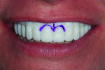 Fig 12. To indicate changes necessary for correcting the patient’s gummy smile, the 3D prototype was marked and returned to the laboratory for processing.
