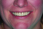 Close-up view of the patient’s smile following implant placement and delivery of the final digital dentures.