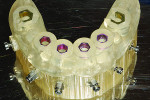 The implant surgical guide would facilitate placement of the four mandibular implants to support the retrofitted digital denture.