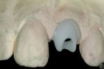 Figure 13 View of the custom ceramic abutment.