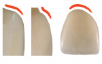 Figure 18 The facial contours
of the original implant-supported
crown are contrasted with the new,
definitive restoration. A linear transition
from the implant platform to
the original crown will displace the
facial gingiva coronally (left), but a
more vertical contour with a defined
CEJ convexity defines the determined
facial and proximal gingival
contours (middle, right).